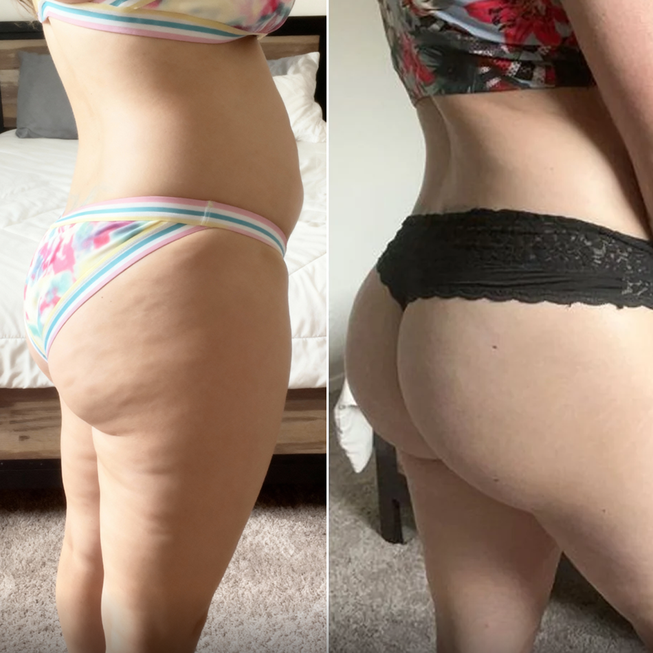 Comparación antes y después en glúteos femeninos mostrando reducción de celulitis con Vibro Sculpt